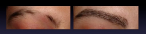 Before and 1 month after of a eyebrow transplantatin with FUE technique
