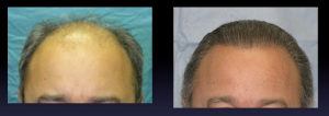 Before and after of a hair transplantation with FUE technique