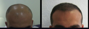Before and after hair transplantation with FUE technique