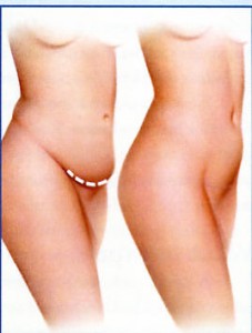 Tummy tuck helps to regain contour of your tummy