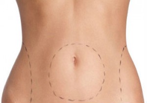 abdominoplasty