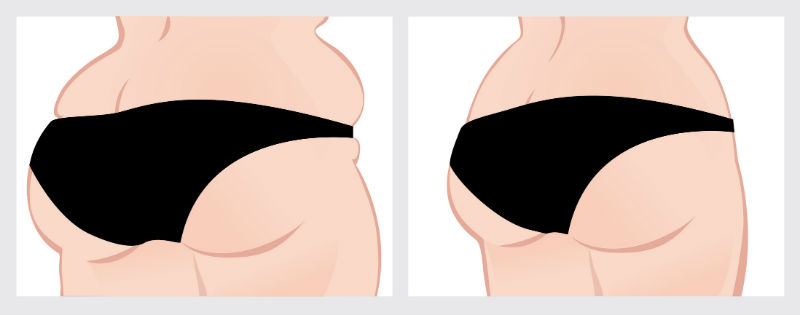 Laser lipolysis for lovehandles and hip area