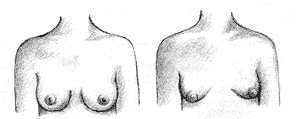 tuberous-breastand-normal-figure-upper
